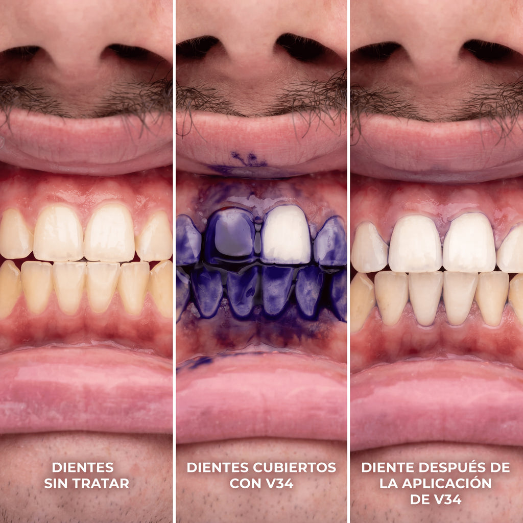 Lumident™ Blanqueador Dental V34 + Regalo